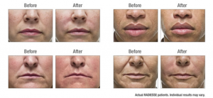 Radiesse Before and After Photo's Several Photo's of Actual Radiesse Patient Results