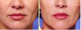 Restalyne is one of 3 popular dermal fillers
