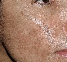 USHR Spa team discusses Melasma