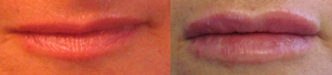 Fillers for Lip Augmentation